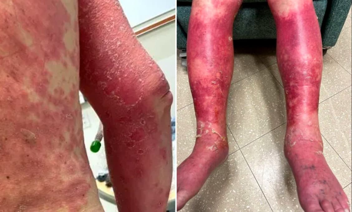 Zoznam vedľajších reakcií na vakcíny sa rozširuje. Čo ešte môžeme čakať?