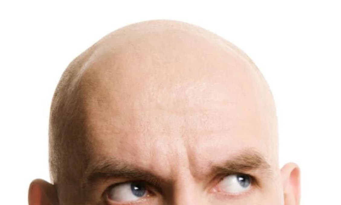 Holohlavosť sa môže týkať aj detí, spôsobuje ju autoimunitné ochorenie