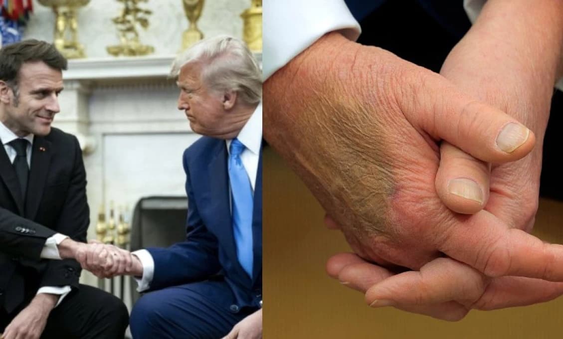Obrovská podliatina na Trumpovej ruke vyvoláva otázky - čo tají o svojom zdraví?