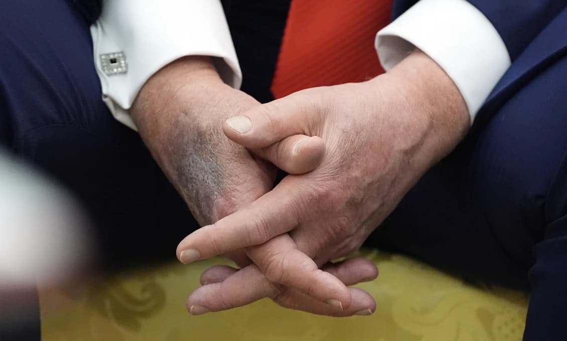 Trumpove ruky sú opäť v centre pozornosti (Konšpirácia)