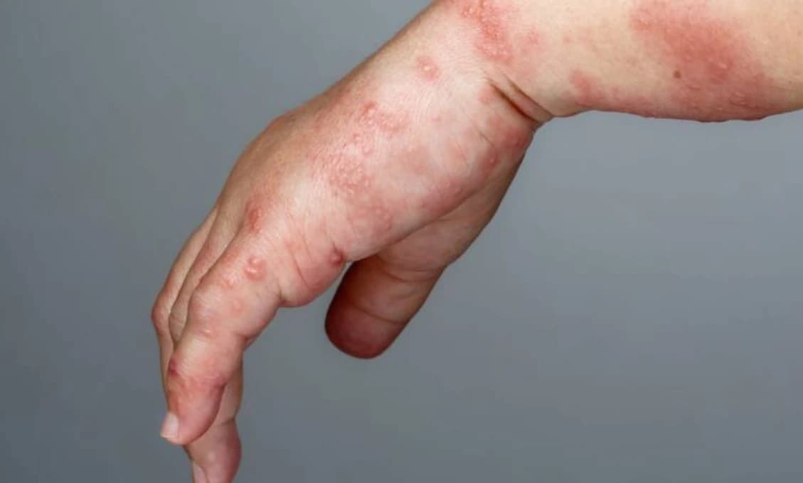 NAJVÄČŠIA EPIDÉMIA ZA 30 ROKOV zasiahla Česko: Štyri úmrtia v súvislosti s komplikáciami, nákaza sa hlási aj na Slovensku