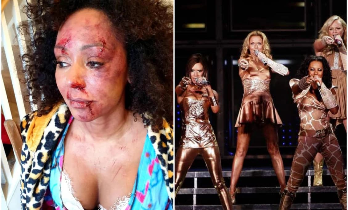 Speváčka zo Spice Girls obeťou domáceho násilia: Snímka jej dobitej tváre obletela internet